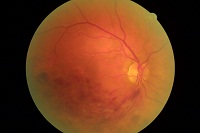 OCT Medoptica